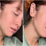 Before and after skincare transformation showing clearer skin.